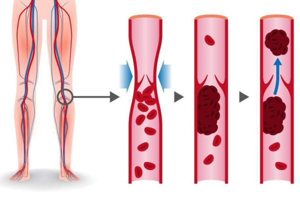 How to Recognize the Early Signs of DVT signs of dvt