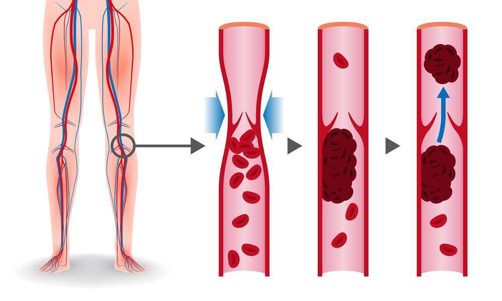 signs of dvt